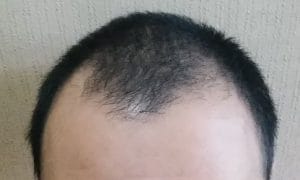 Mハゲ